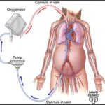 ECMO in Pregnancy: Analysis of Indications, Management and Outcomes