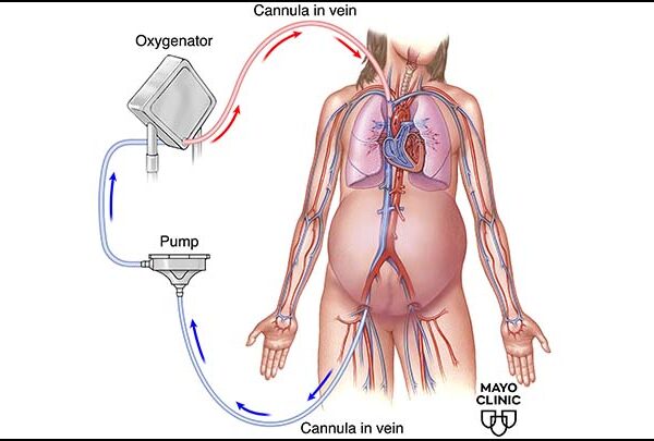ECMO in Pregnancy: Analysis of Indications, Management and Outcomes