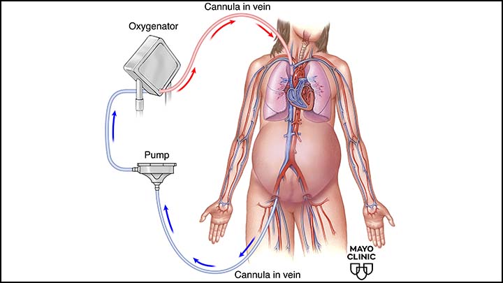 ECMO in Pregnancy: Analysis of Indications, Management and Outcomes